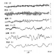 病人不发作的时候，做脑电图可不可以?
